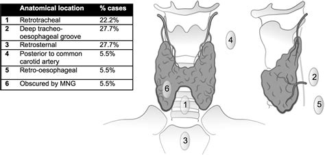 Parathyroid Tumor Ultrasound