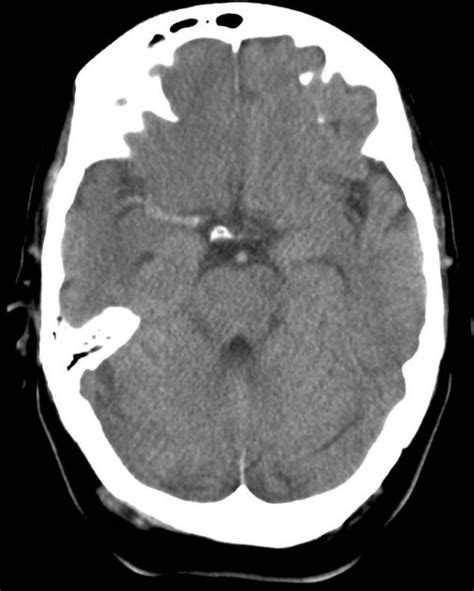 Hyperdense MCA Sign Radiology Blog Post, 40% OFF