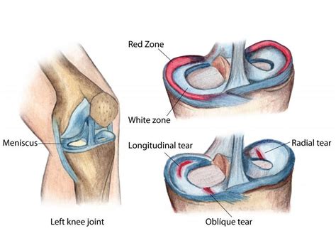 Do I need surgery for my meniscus tear?: Colorado Sports Medicine ...