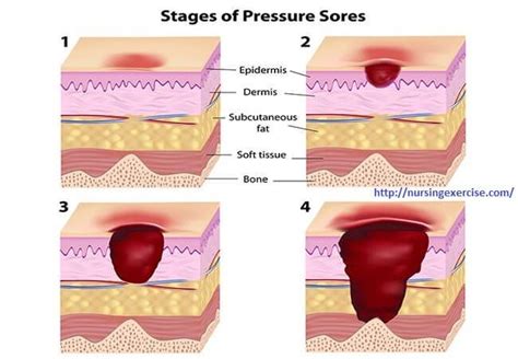 Bedsore stages | Pressure ulcer, Ulcers, Soreness