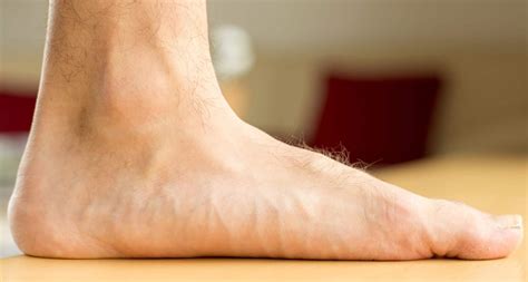 Pes Planus - Causes & Treatment for Flat Feet - Limbionics