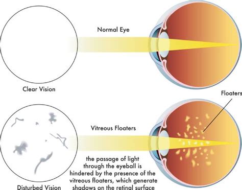 Eye Floater Treatment in Kansas | The EyeDoctors Optometrists