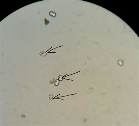 Calcium Oxalate In Urine