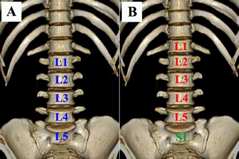 Figure 2 from The association between lumbar rib and lumbosacral ...