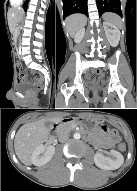 Computed tomography of the abdomen and pelvis - Wikipedia