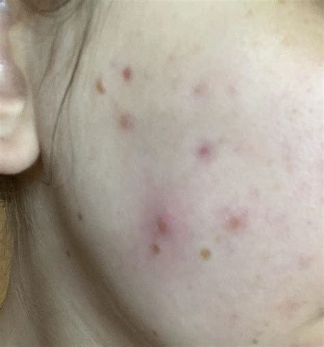 [ACNE] Cystic acne scars. What helped you?? : r/SkincareAddiction