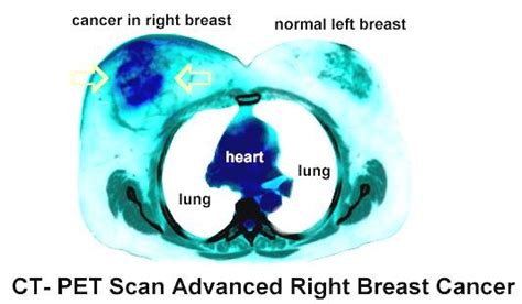 Breast PET Scans