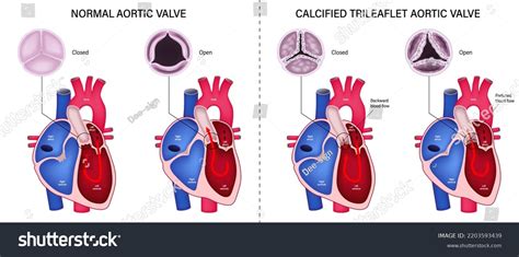 12 Calcified Aortic Valve Images, Stock Photos & Vectors | Shutterstock