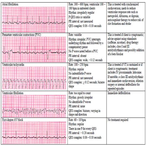 13 Cardiac Rhythm and Dysrhythmias Cheat Sheet Any Nurse Must Know for ...