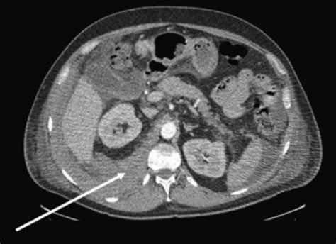 Retroperitoneal Hematoma in the ED - emdocs