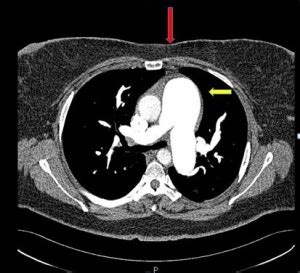 CT Scan Test for Pulmonary Arterial Hypertension | Interstitial Lung ...