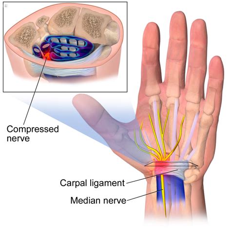 What are the symptoms of a median nerve injury? | Top Doctors