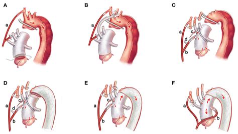 Elephant Trunk Procedure Stages