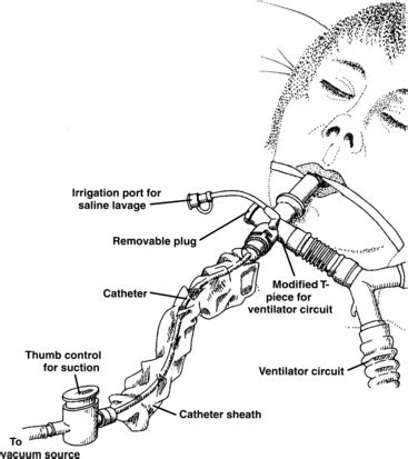 Tracheostomy Suctioning Procedure