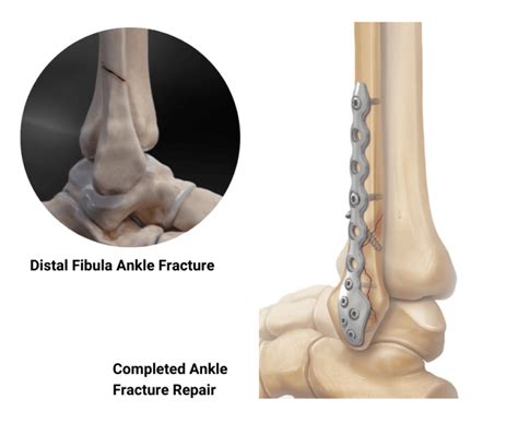 Tibia And Fibula Fracture Surgery