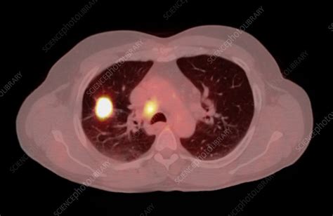 Non-small cell lung cancer, CT/PET scan - Stock Image - C007/1648 ...