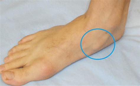 Accessory Navicular | Dr Ben Beamond | Adelaide