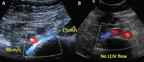 Diagnosis of Iliac Vein Obstruction With Duplex Ultrasound ...