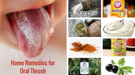 8 Best Home Remedies for Oral Thrush