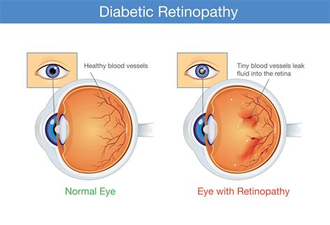 Signs, Causes, and Treatments of Diabetic Retinopathy - Facty Health