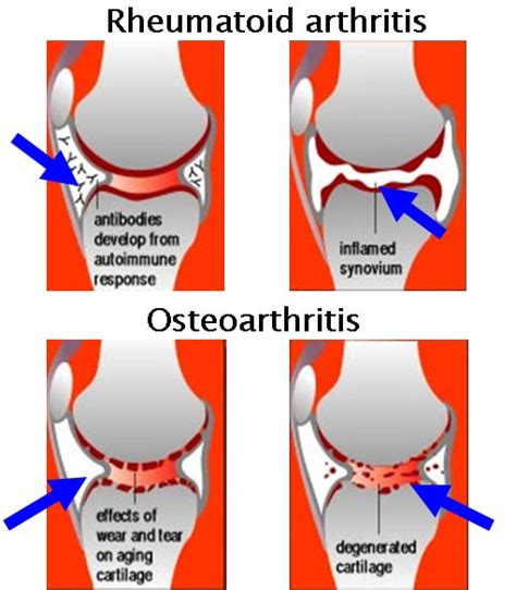 Inflammatory Arthritis of the Hip - Robert Howells