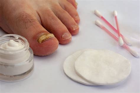 What Is The Best Topical Treatment For Nail Fungus? - Nycfellowship