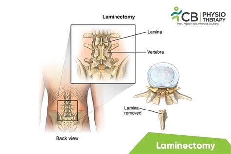 What is Laminectomy? Symptoms, Causes, Diagnosis & Physiotherapy ...