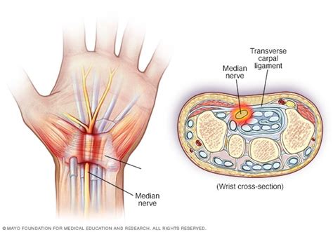 Pinched nerve - Symptoms and causes - Mayo Clinic