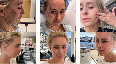 Our Patient's Journey: Recovery After a Deep Plane Facelift — Kassir ...