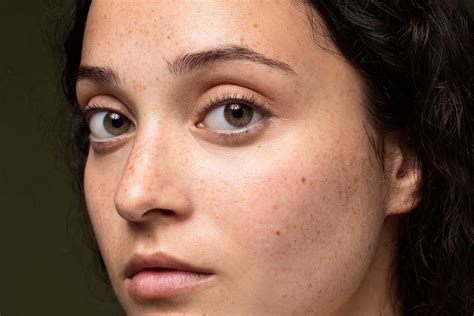 Understanding Melasma: Causes, Treatments, and Prevention - Skincentral