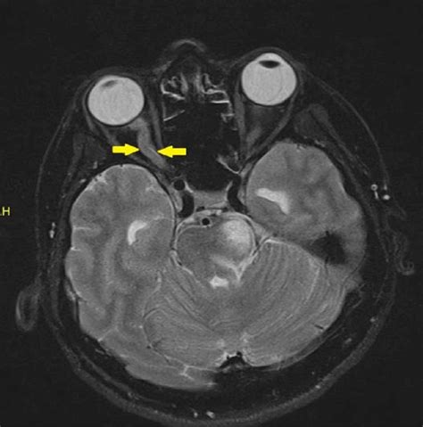 Cureus | Optic Perineuritis in Neuromyelitis Optica Spectrum Disorder