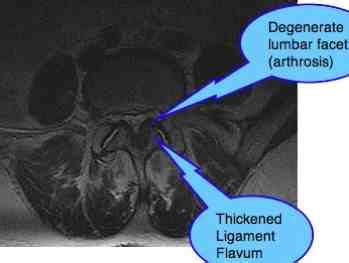 Lumbar Facet Arthropathy Spondylolysthesis causes lower back and leg pain.