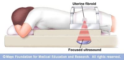 Focused ultrasound surgery for uterine fibroids - Mayo Clinic