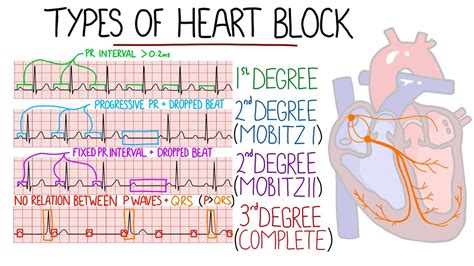 Heart Block Av Second Degree at James Ruppert blog