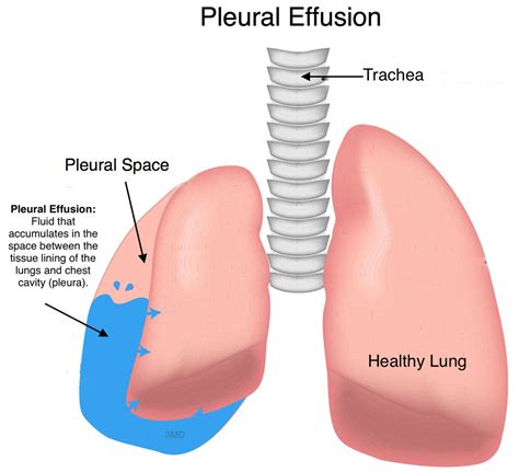 pleural-effusion - Pediatric Pulmonologists