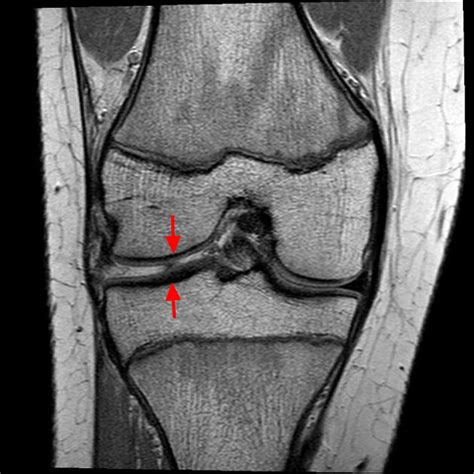 Torn Meniscus - Signs & Symptoms, Test, Diagnosis, Recovery, Treatment