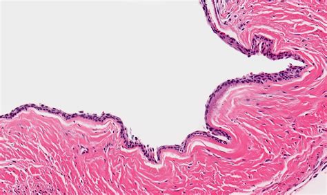 Radicular Cyst Pathology Outlines