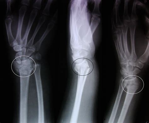 piyatida: Body Dysfunction 6 ( โรค Colles' fracture)