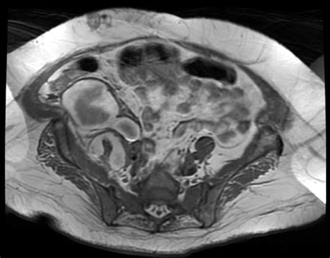 Retroperitoneal hematoma - wikidoc