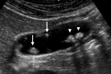 Gallbladder Polyps Ultrasound