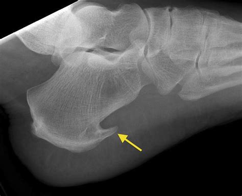 Spur Calcaneus Radiology | Hot Sex Picture