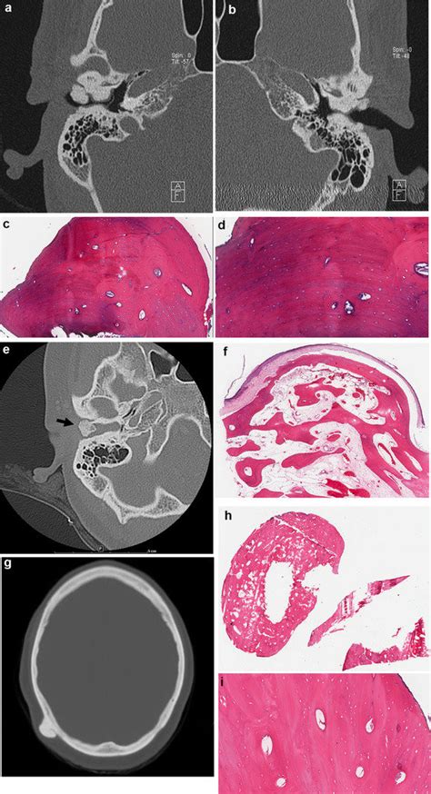 Exostoses/osteoma. a and b Axial view of CT demonstrating bilateral ...