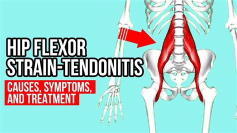 Hip Flexor Strain-Tendonitis? Causes, Symptoms, And Treatment - YouTube