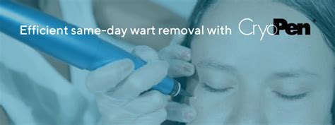 CryoPen: Using Cryotherapy for Wart removal | IV SITE