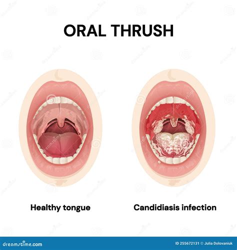 Oral Thrush. Candidiasis. Symptoms.Candida Infections of the Mouth ...