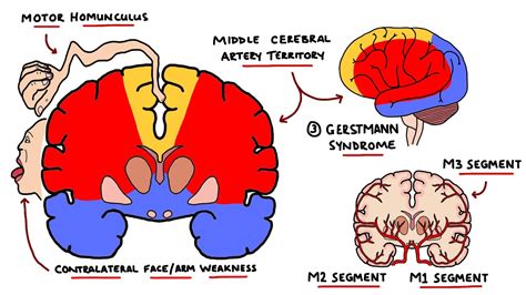 Middle Cerebral Artery Stroke Syndromes | MCA Stroke Syndromes (With ...