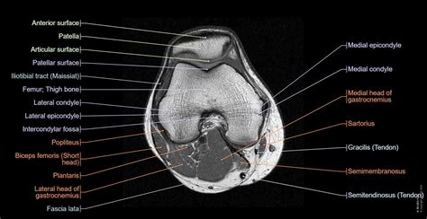 Nappali gyülekezik tavacska leg mri anatomy rajtaütés Ázsia Langyos