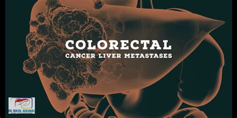 Colorectal Cancer Liver Metastases: Treatment and Surgery | Dr. Nikhil ...