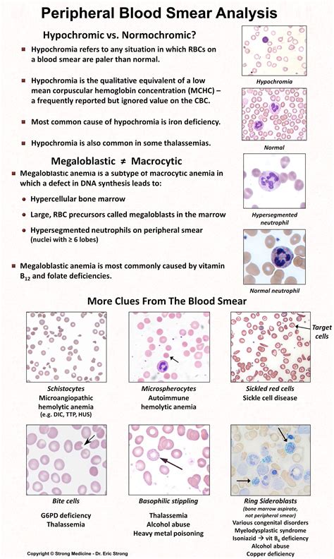 Megaloblastic Anemia Peripheral Smear