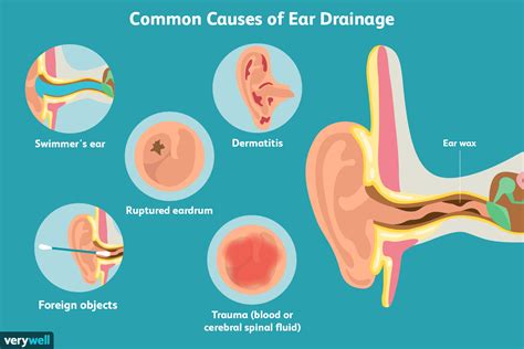 Ear Drainage: Causes and Treatment